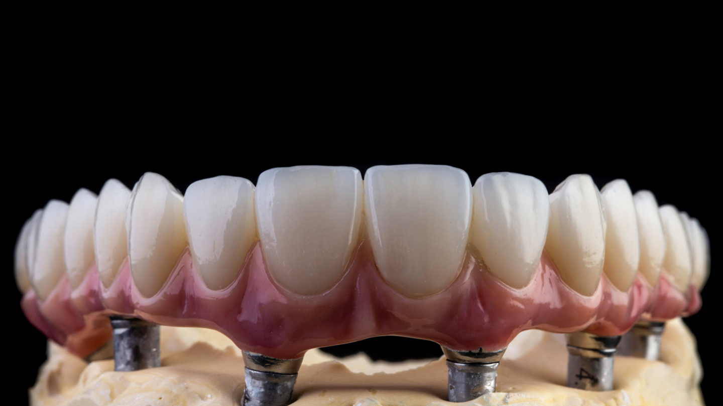 Implant Bridge